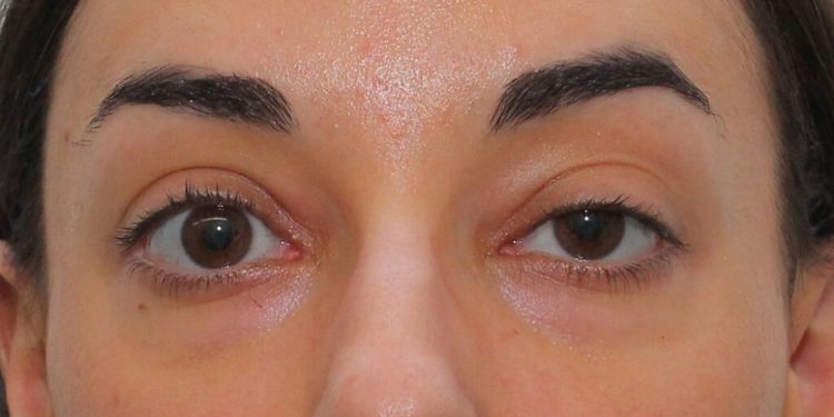 Causas y factores de riesgo de la ptosis o párpado caído El